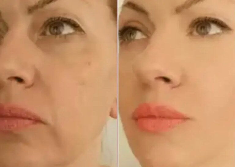 Before and after: Tired under-eyes, volume restored