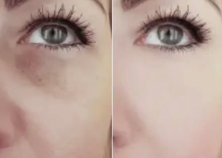 Before and after: Tired under-eyes, volume restored