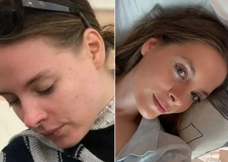 Before and after: Skin barrier repaired, volume restored